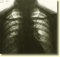 X-ray of Lungs